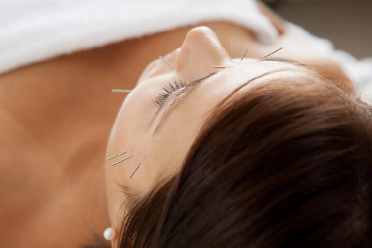 Cosmetic Acupuncture