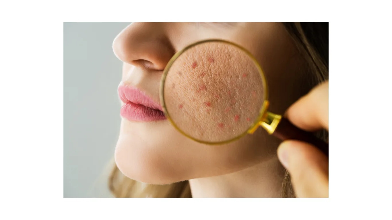 Close-up view of acne marks and uneven facial skin texture