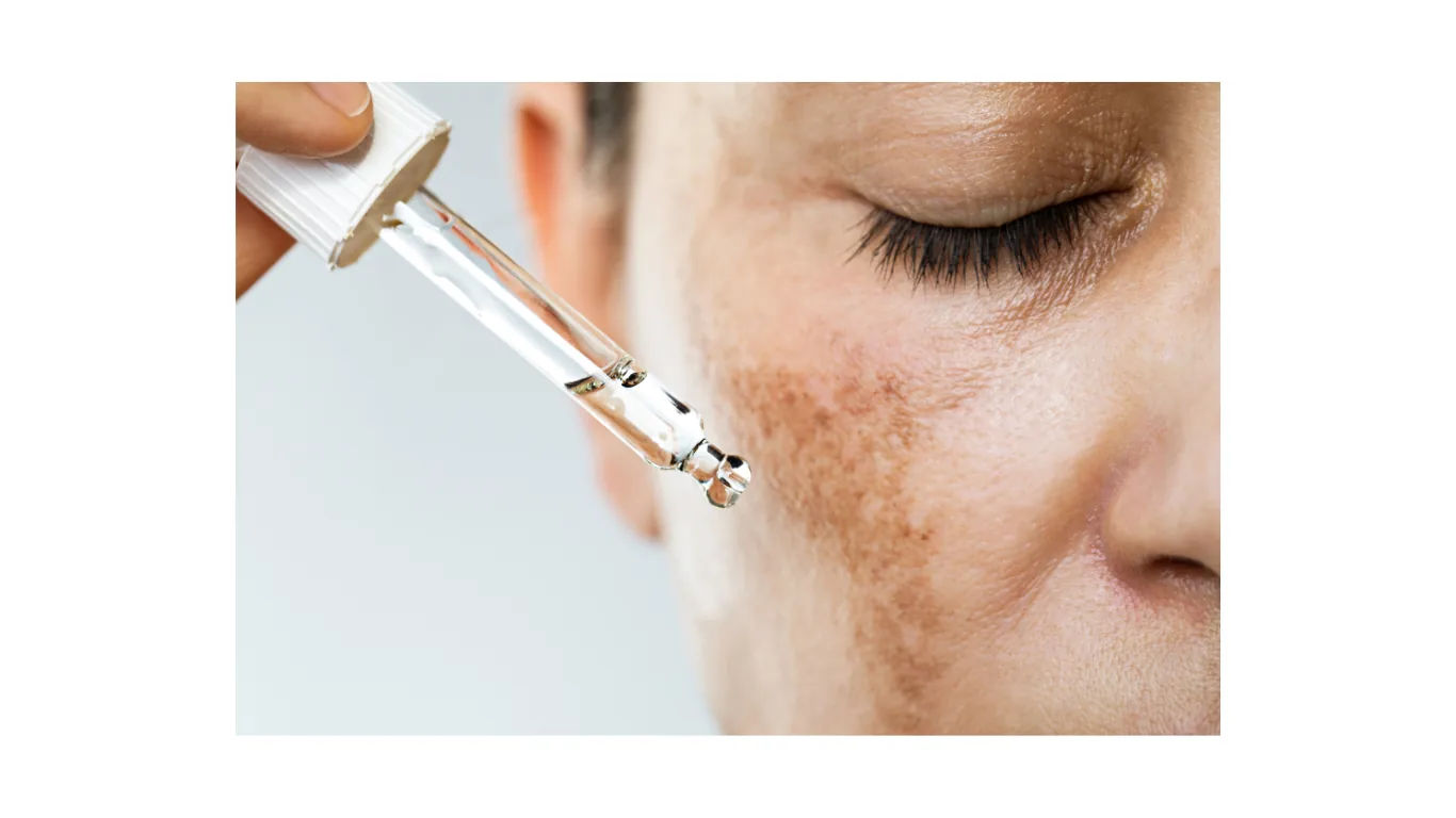 Close-up of facial hyperpigmentation and uneven skin tone